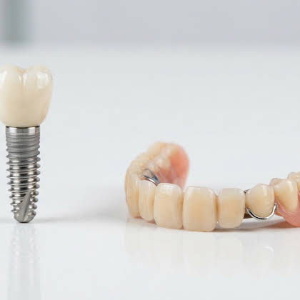Implants vs Dentures